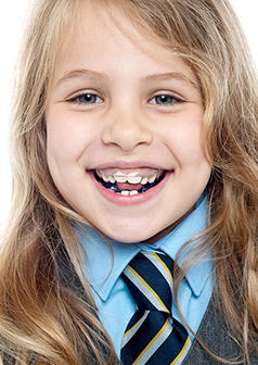early orthodontic treatment